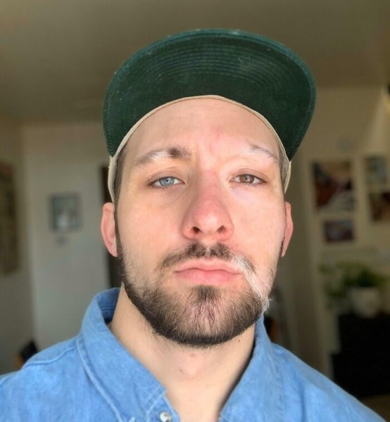 На этих фото показали, какие финты генетика вытворяет с людьми