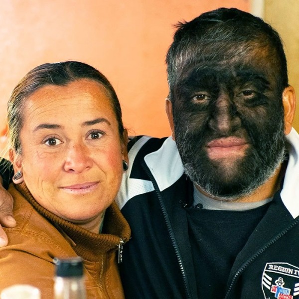 На этих фото показали, какие финты генетика вытворяет с людьми