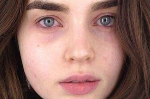 Почему возникают синяки под глазами, как от них избавиться?