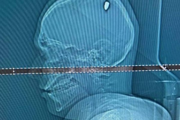 Мужчина четыре дня ходил с пулей в голове: что с ним сейчас?