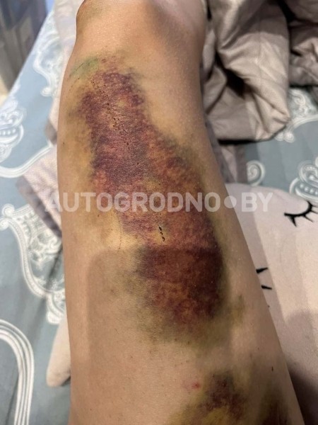 На опасной велодорожке девушка сломала три ребра и ключицу